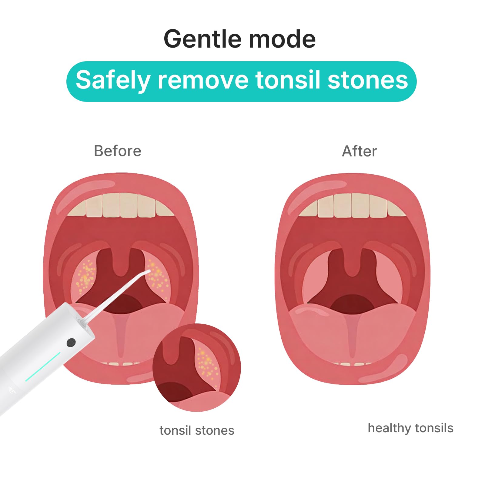 Water Flosser Safe Amígdala removedor de piedras para evitar el mal aliento, color blanco | Máquina de hilo dental portátil inalámbrica recargable de viaje, imprescindible para frenos, puentes, IPX7