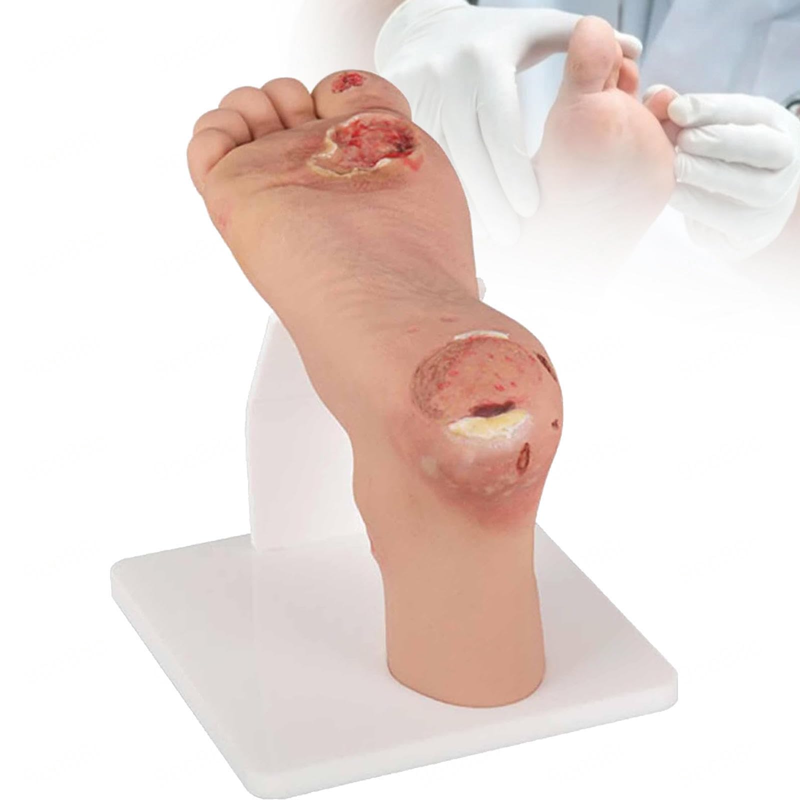Diabetic Foot Model, 1:1 Scale Mild and Severe Pathological Contrast, Anatomy for Training Nursing Podiatry, Simulation Classification Ulcers, Mild