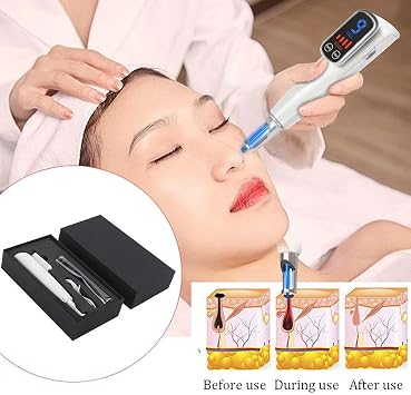 Professional Picosecond Laser Pen, Red Blue Light, Mole Freckle Dark Spot MelaninTattoo Removal Pen, 9 Levels of Frequency + 4 Levels of Intensity, Touch Screen,Blue