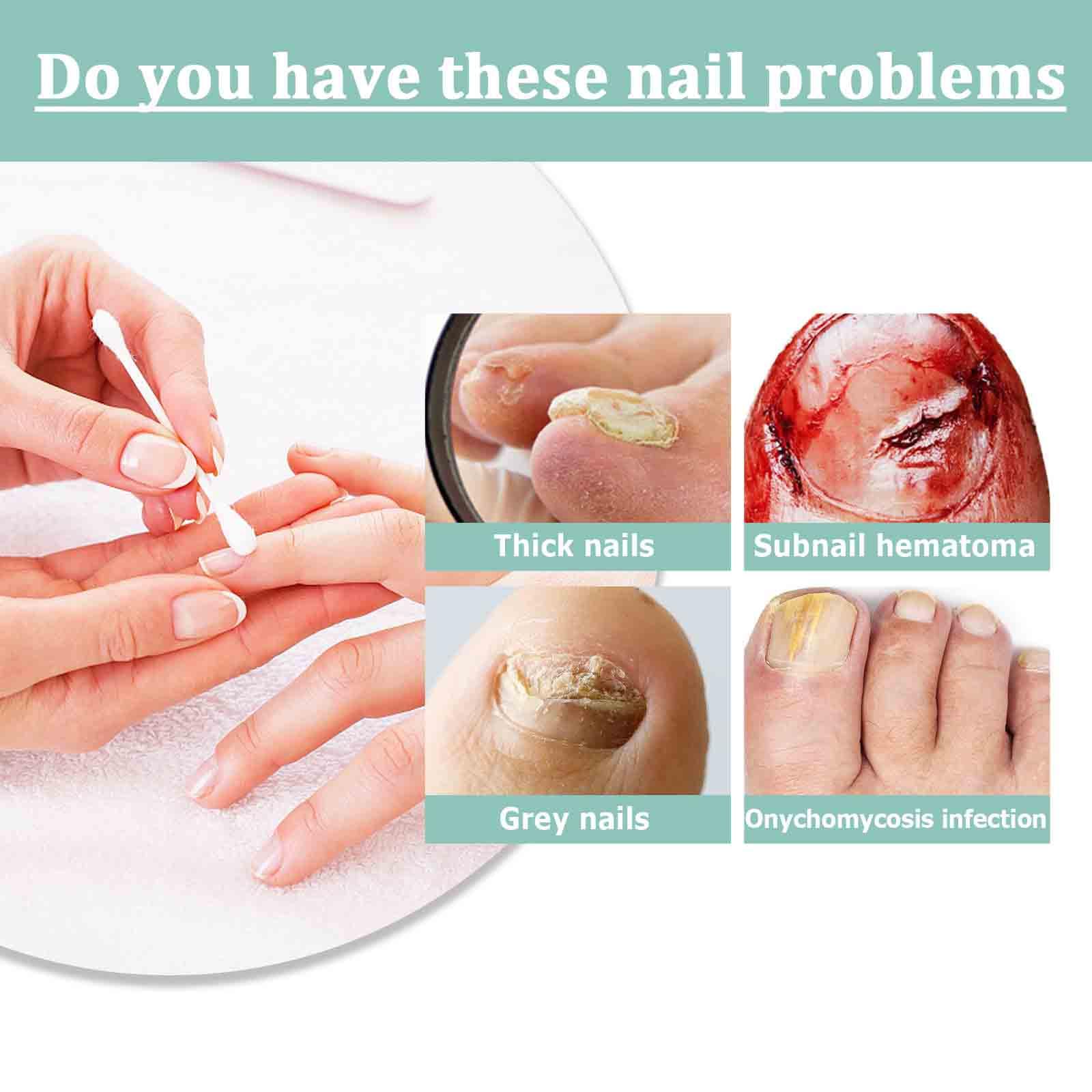 5Pcs Nail Fungus Treatment Pen - Image 2