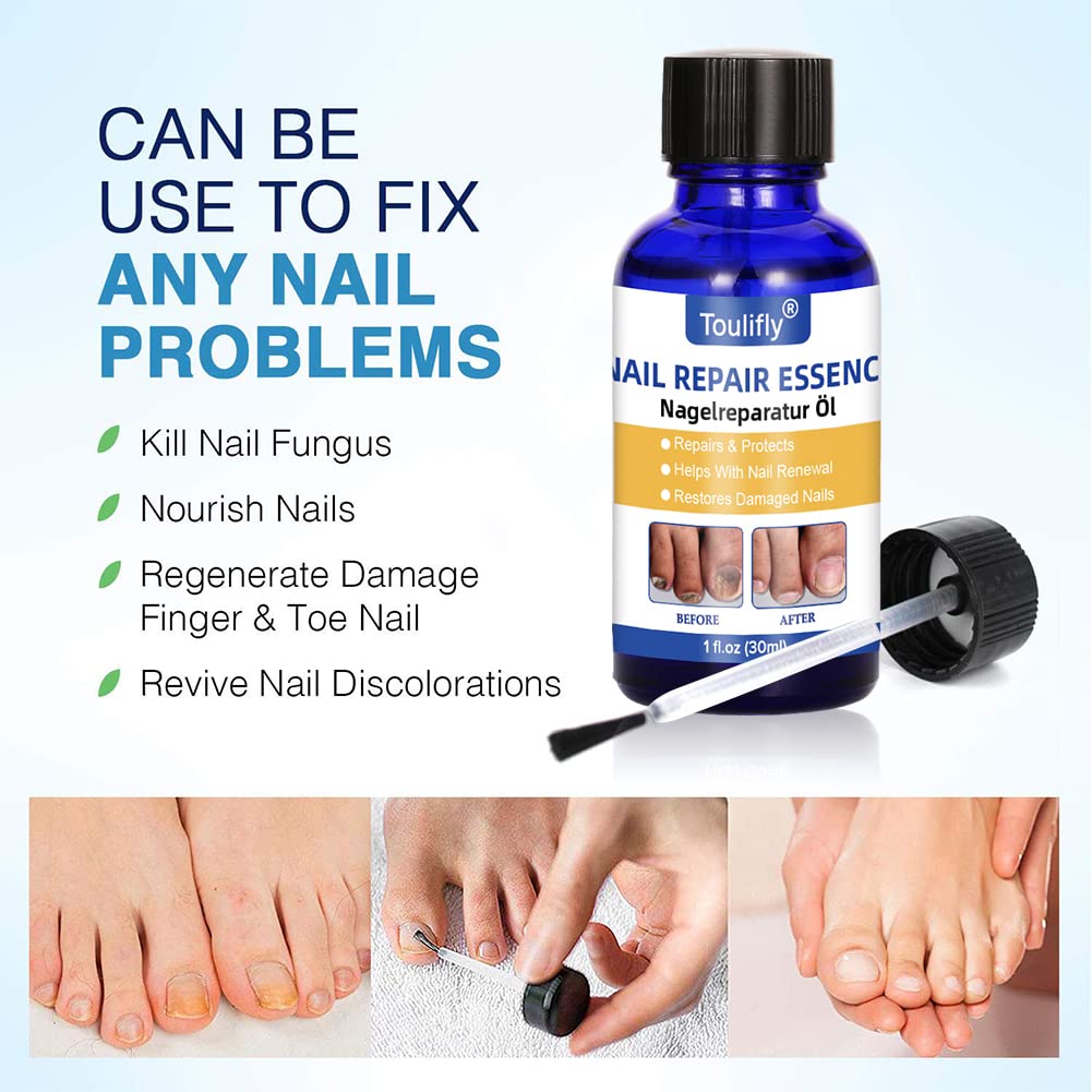 Buy Nail Fungus Treatment for Toenail, Toenail Fungus, Nail Fungus