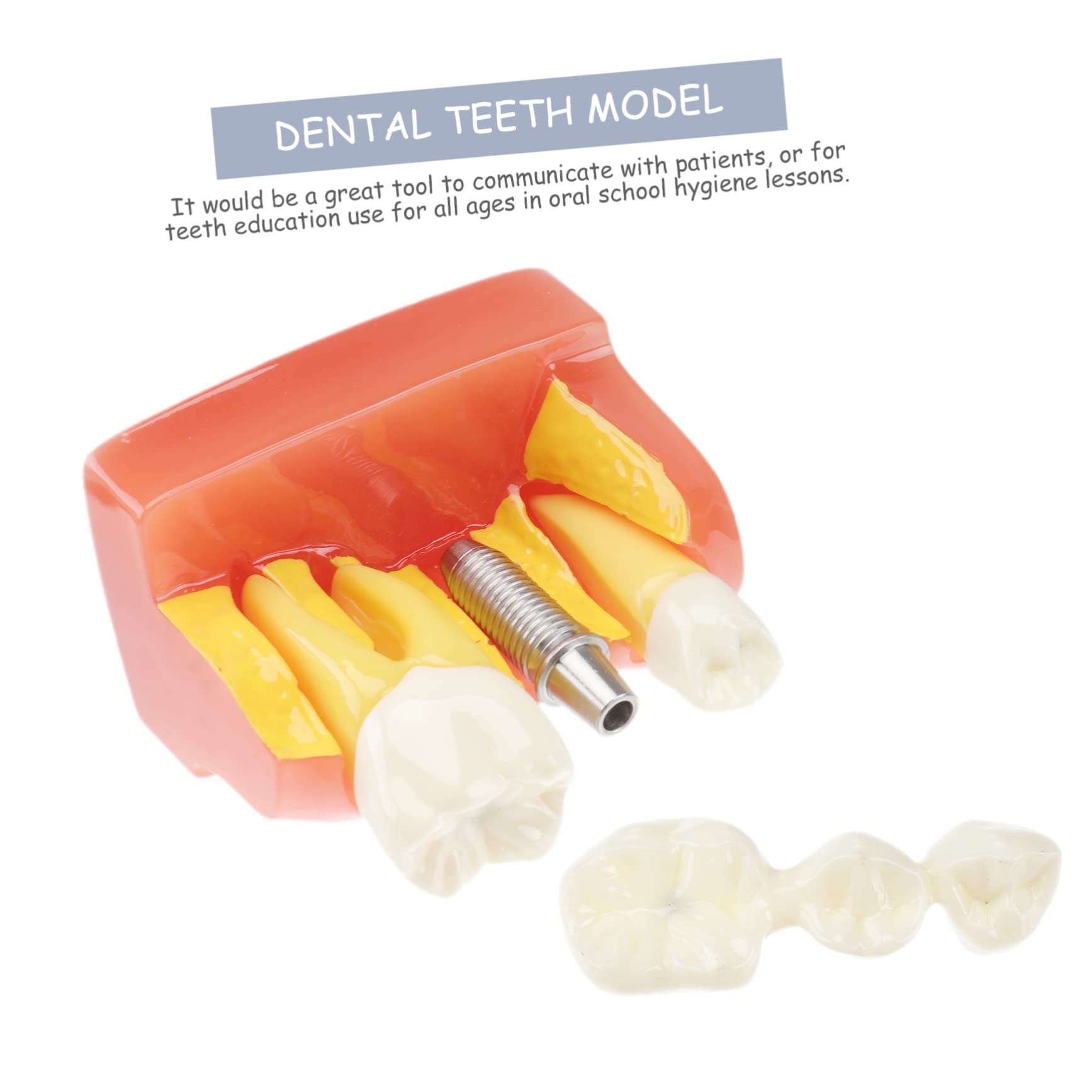 1pezzi Modello di Denti con Denti Rimovibili Strumento Didattico per Insegnamento e Studio Odontoiatrico Modello di Impianto e Protesi Fissa Incluso