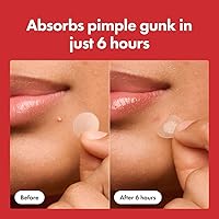 Vista 4 de Mighty Patch Original - Parches hidrocoloides de Hero Cosmetics - #1 para el acné y espinillas en la cara, reduce granos y puntos blancos en un uso