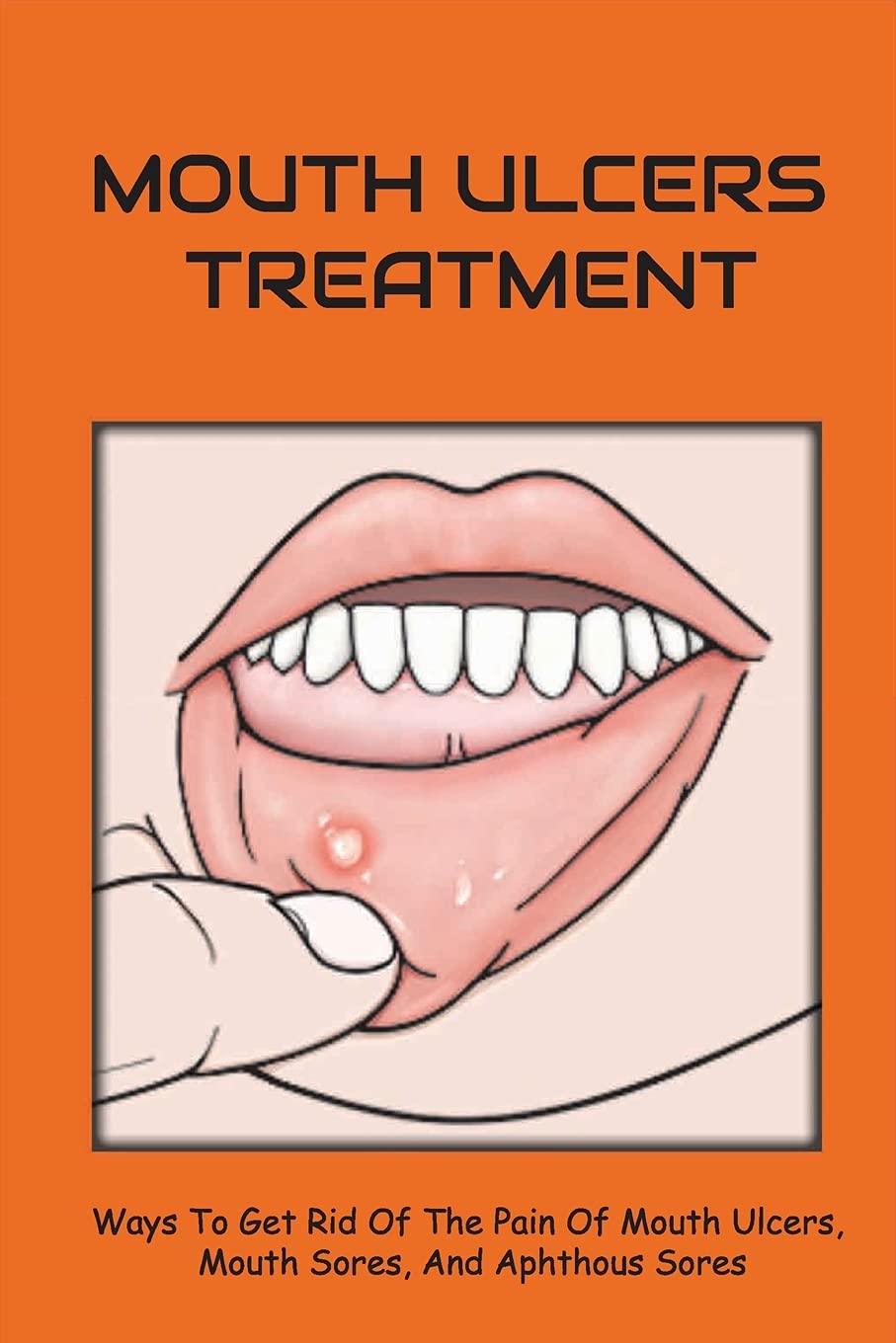 Buy Mouth Ulcers : Ways To Get Rid Of The Pain Of Mouth Ulcers, Mouth