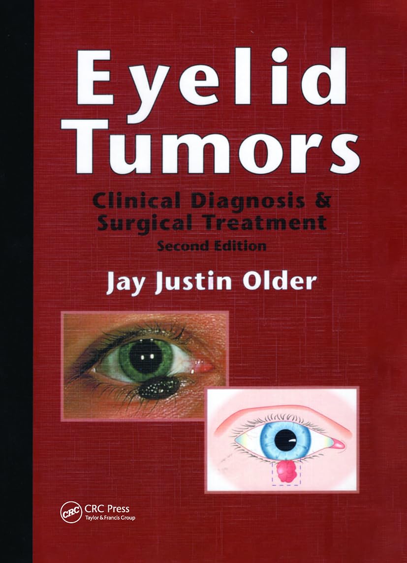 Buy Eyelid Tumors 2/e — BookShops.in