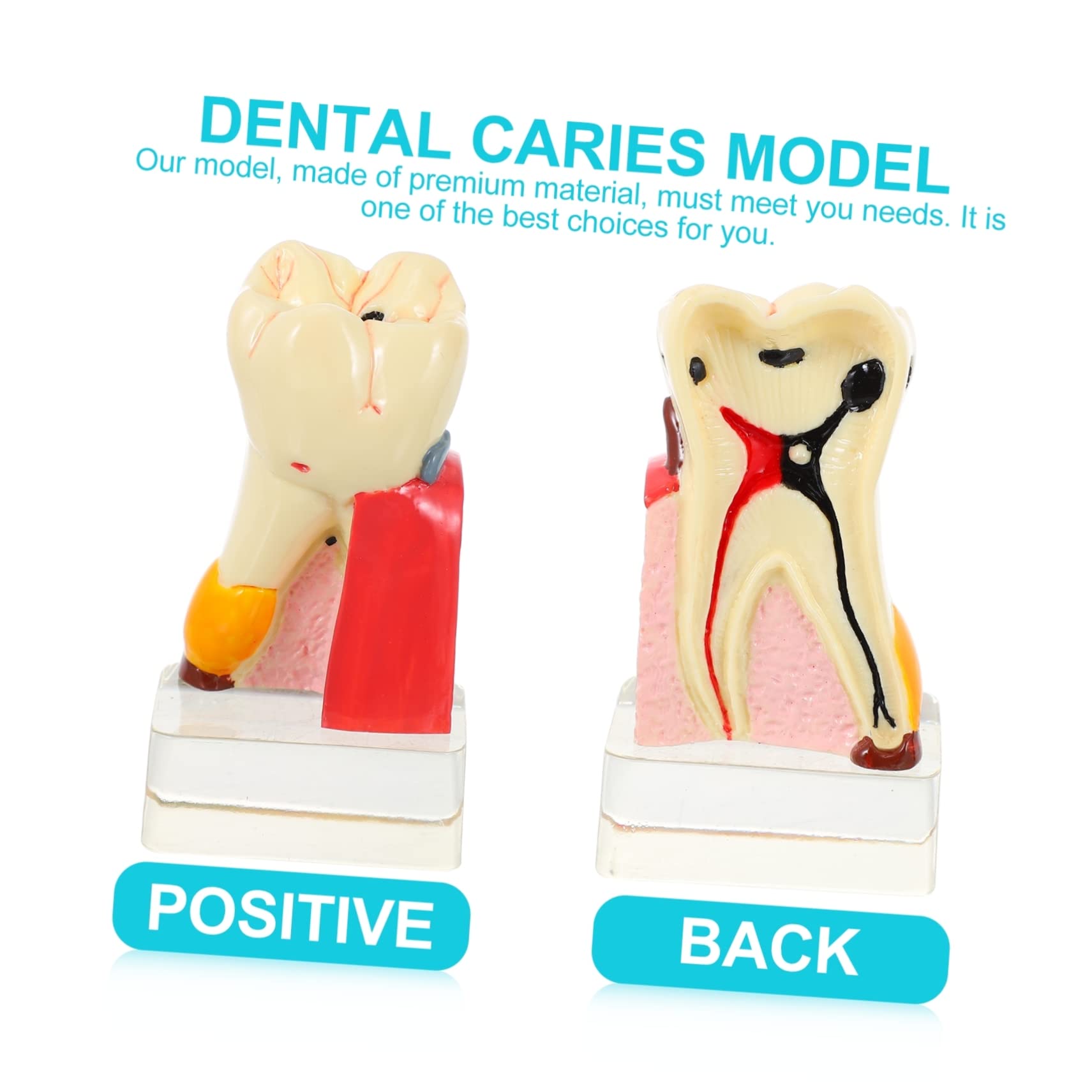 Modello Anatomico del Dente 4x per Carie, Resina, Didattico | Beige, per Dimostrazione e Insegnamento Odontoiatrico, Formato Compatto per Studio e Spiegazione