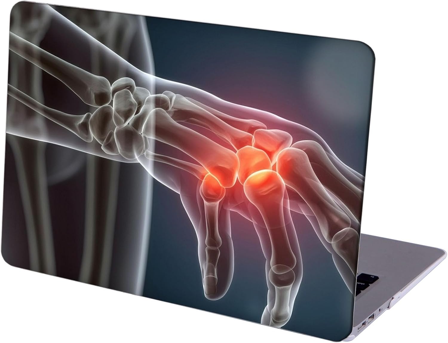 Compatible with MacBook Neo 13-inch, Hard Shell Case with Keyboard Cover and Screen Protector (A3404 A18 Pro chip, 2026 Release) - X Ray Skeleton MC23427