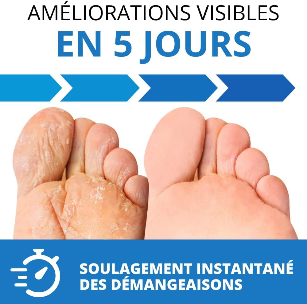 Imperial Feet Crème de Traitement contre le Pied d'Athlète 75 ml-Crème Puissante contre la Teigne, Soulagement des Démangeaisons & Soin des Ongles-Dose XL à Action Rapide, Apaisante pour Peau Sèche