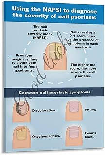 Nail Psoriasis Guide - NAPSI Scoring Nail Health Poster Dermatology Doctor Education Wall Art Canvas Painting Wall Art Poster for Bedroom Living Room Decor 12x18inch(30x45cm) Frame-style