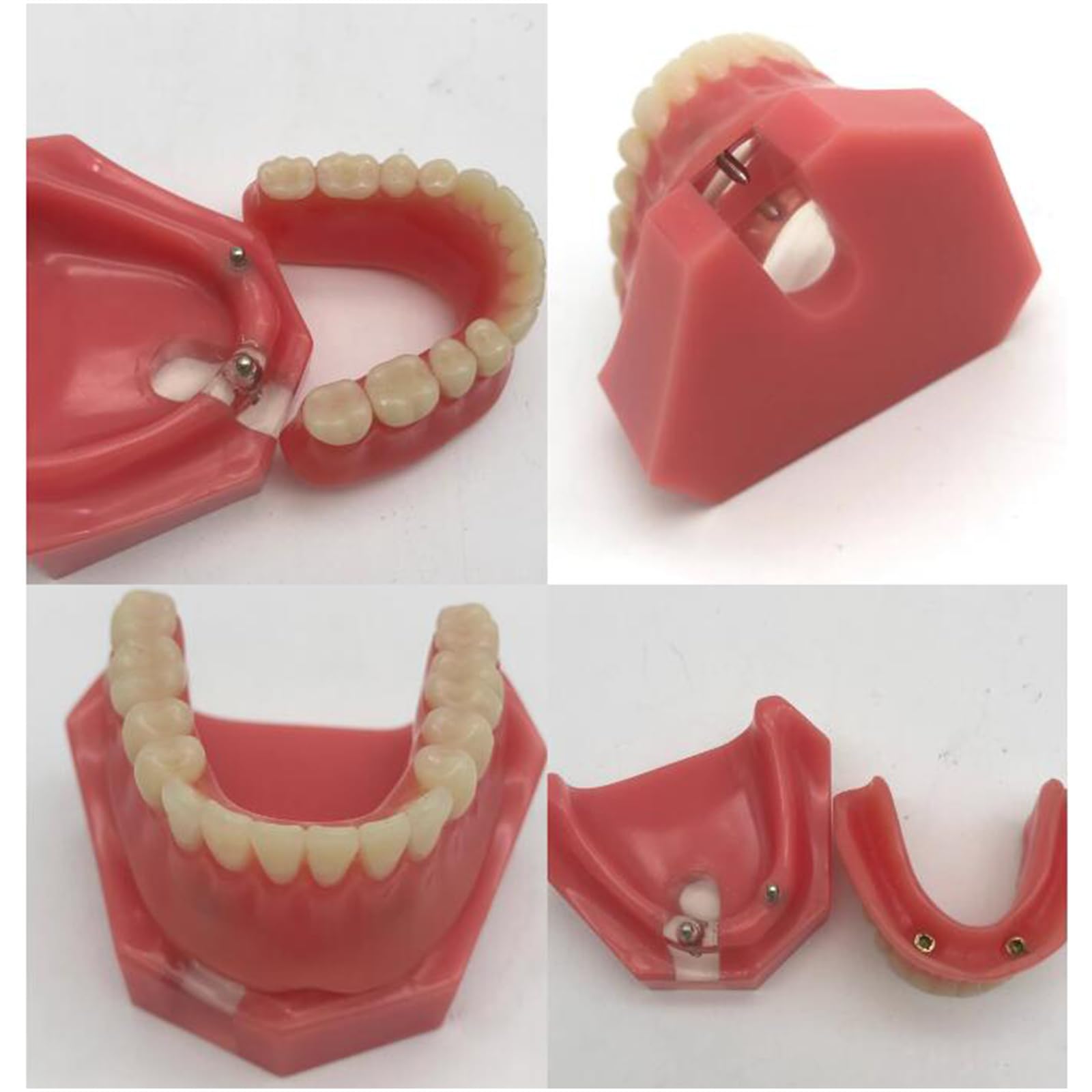 Modello di Denti dentali, Modello di restauro Dentale con 2 impianti, per Laboratorio odontotecnico di Ricerca didattica odontoiatrica