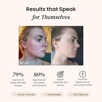Clarity and Renewal Duo The New 2-Step Minimalist System to Gently Exfoliate, Calm, and Control Breakouts While Preventing Fine Lines and Wrinkles Recommended for Sensitive Skin