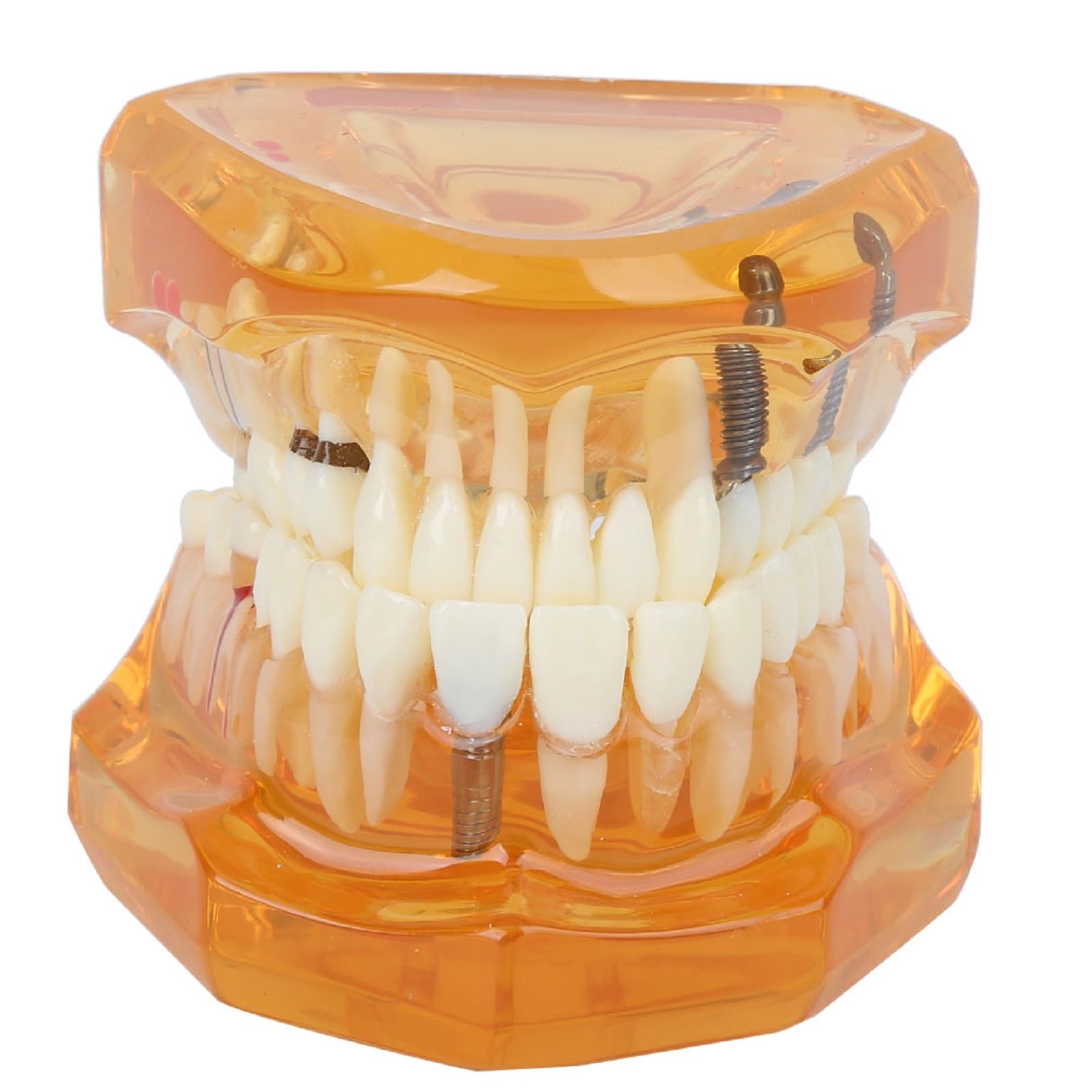 Modelo de Estudio de Dientes Dentales Extraíbles para Enseñanza Demostración Sobredentadura Maxilar Clínica Laboratorio Dentista