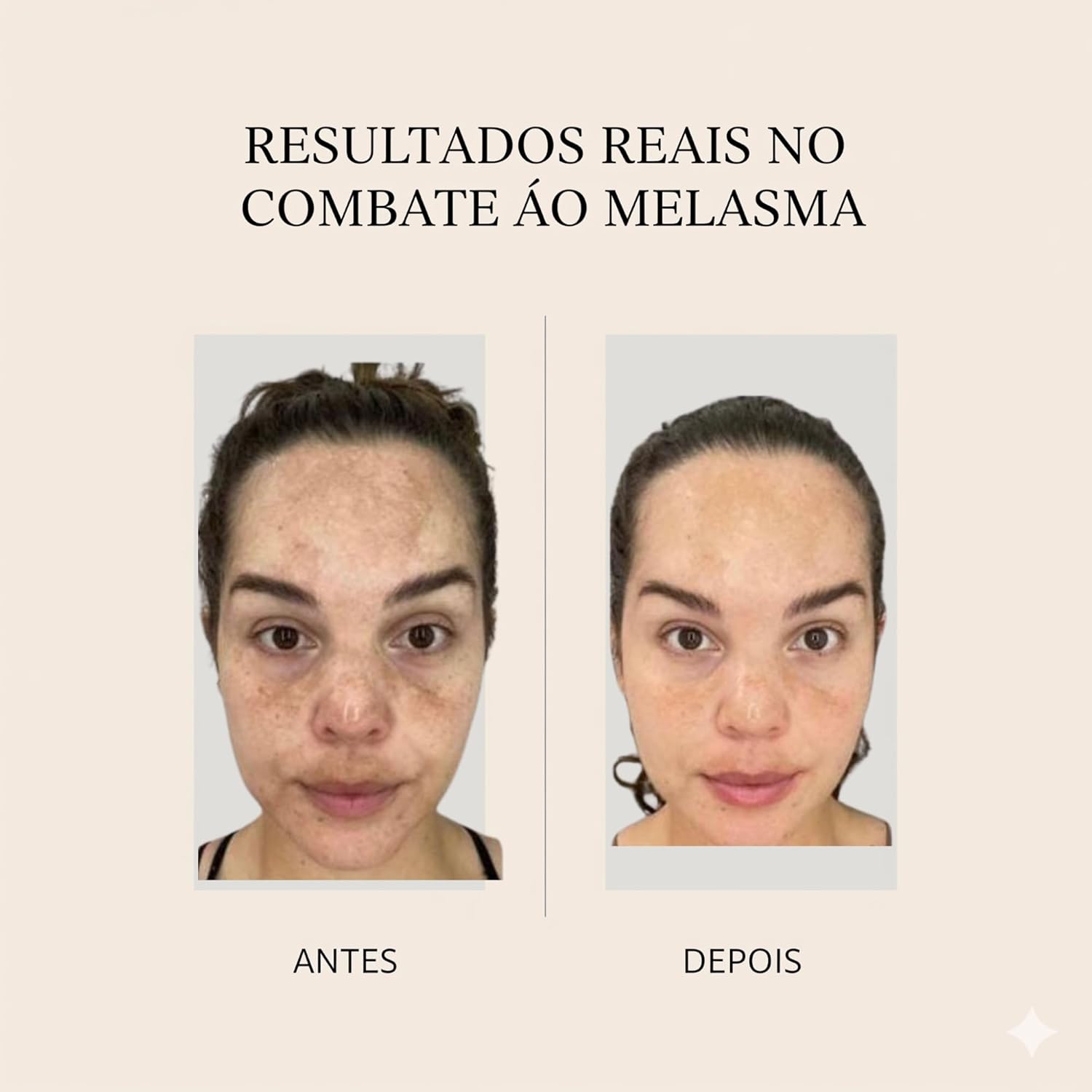 Creme Facial Anti-Idade e Clareador de Manchas | Tratamento para Melasma, Acne, Rugas e Olheiras | Com Colágeno e Elastina para Efeito Lifting | Uso Noturno 25g em promoção! Veja a oferta e mais achadinhos de Tratamentos 5 Hoje é o melhor dia para comprar Creme Facial Anti-Idade e Clareador de Manchas | Tratamento para Melasma, Acne, Rugas e Olheiras | Com Colágeno e Elastina para Efeito Lifting | Uso Noturno 25g com aquele preço maroto! Promoção! Aproveite a oferta! 5