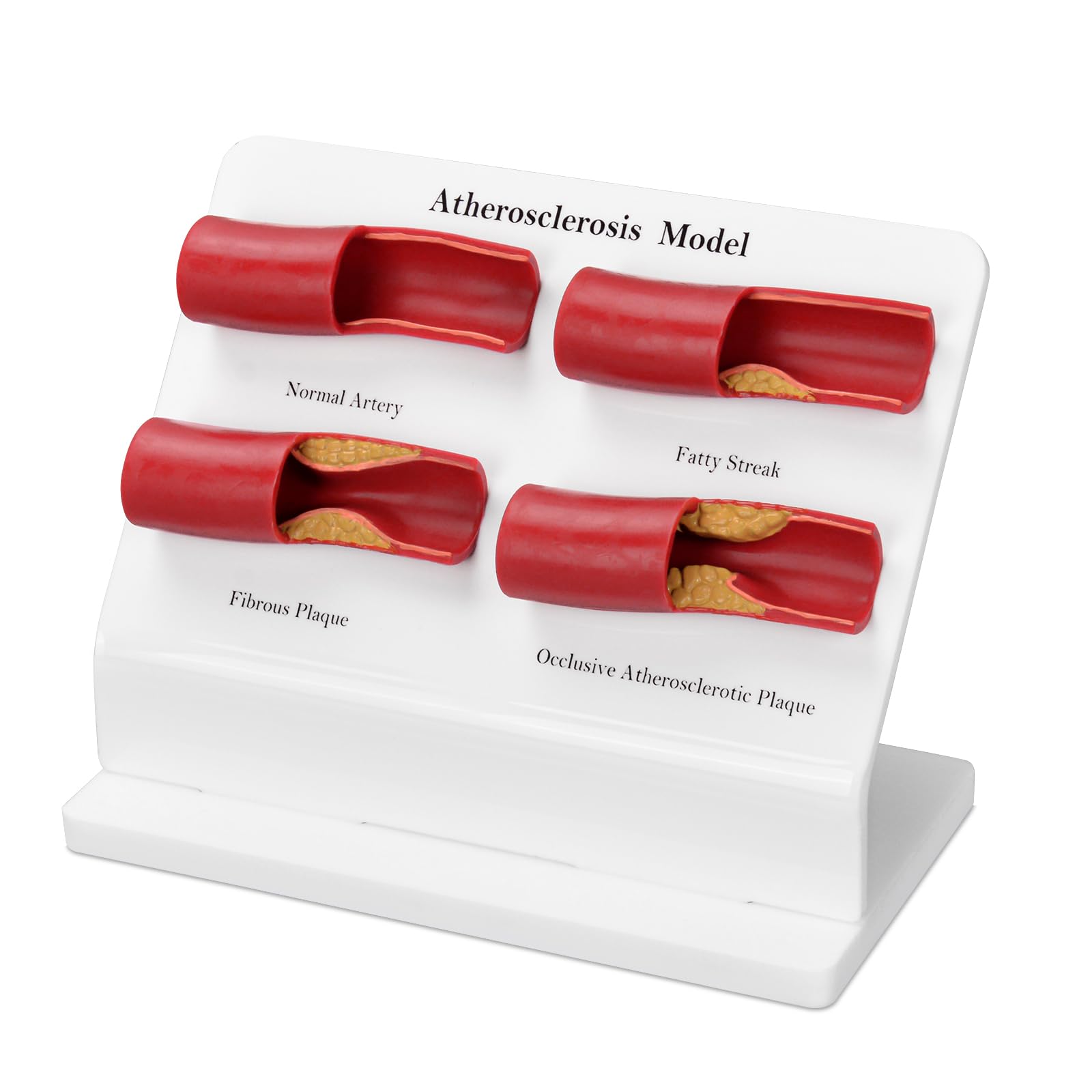 Human Atherosclerosis Model, Vascular Disease Model, Artery with Plaque for Human Anatomy and Physiology Education, Cardiovascular Health Demonstration Tool