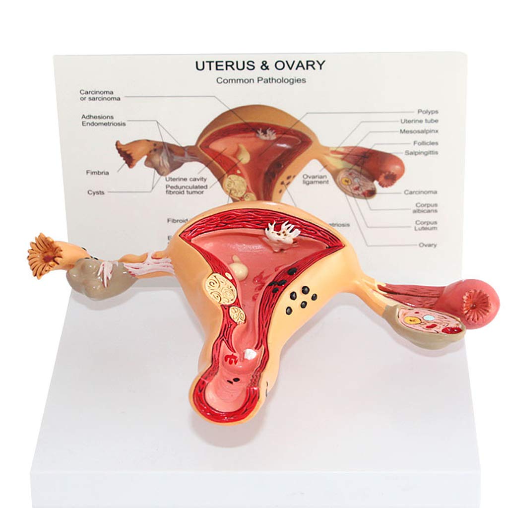 Sjdopulse Women's Anatomical Science Model Of Internal And External Organs - Uterine Lesion Model - Human Organ Anatomy Model Uterine Model - For Study Display Medical Teaching Model