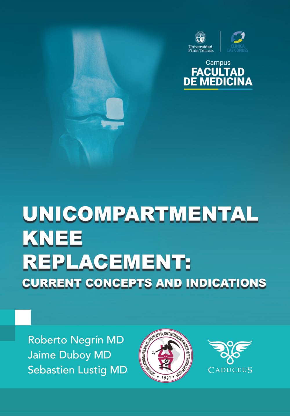 Unicompartmental knee replacement: Current concepts and indications
