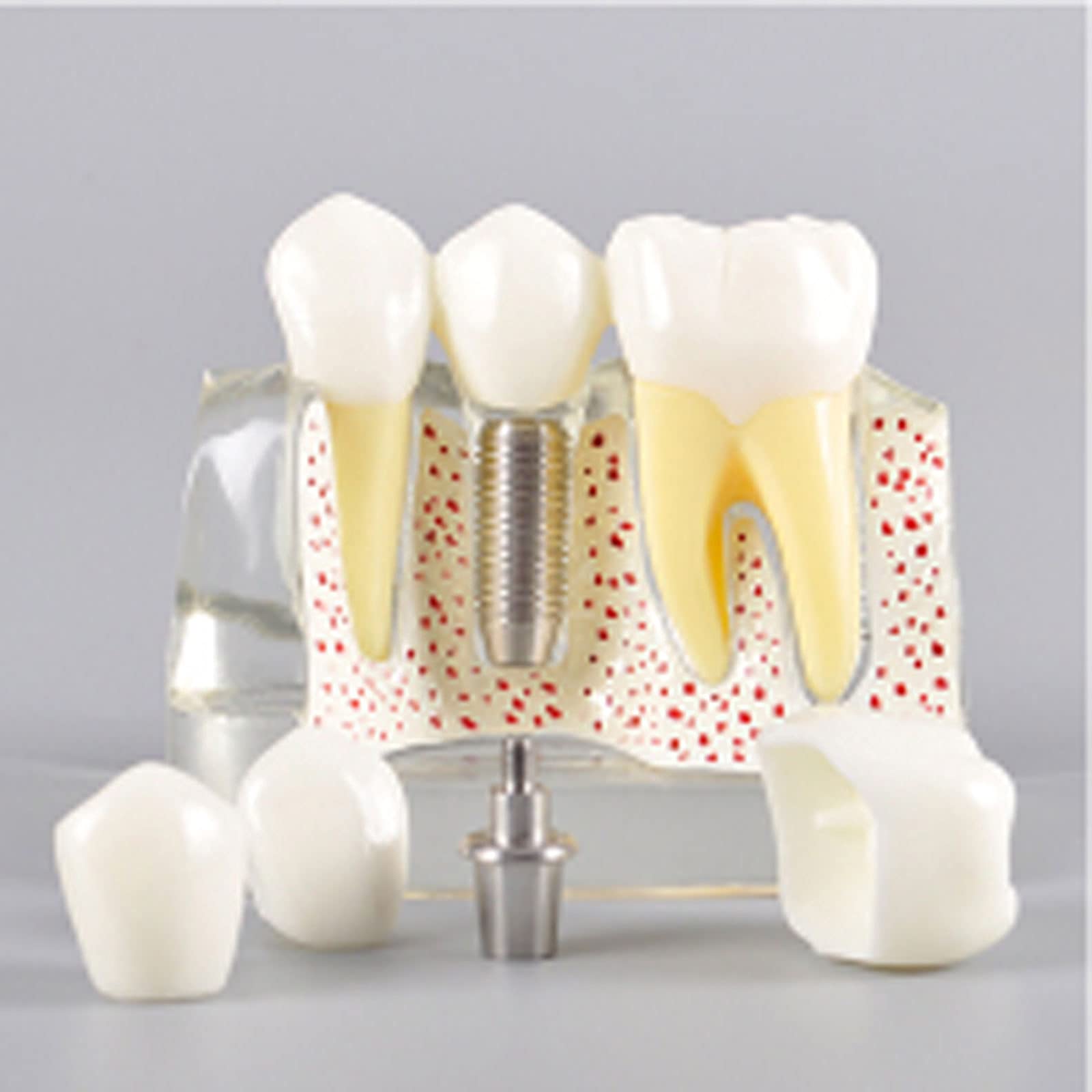 YYZYL Modèle Dentaire Pédagogique, Modèle de Dent D'implant Dentaire, Modèle D'interprétation des Implants pour Démonstration D'enseignement Dentaire