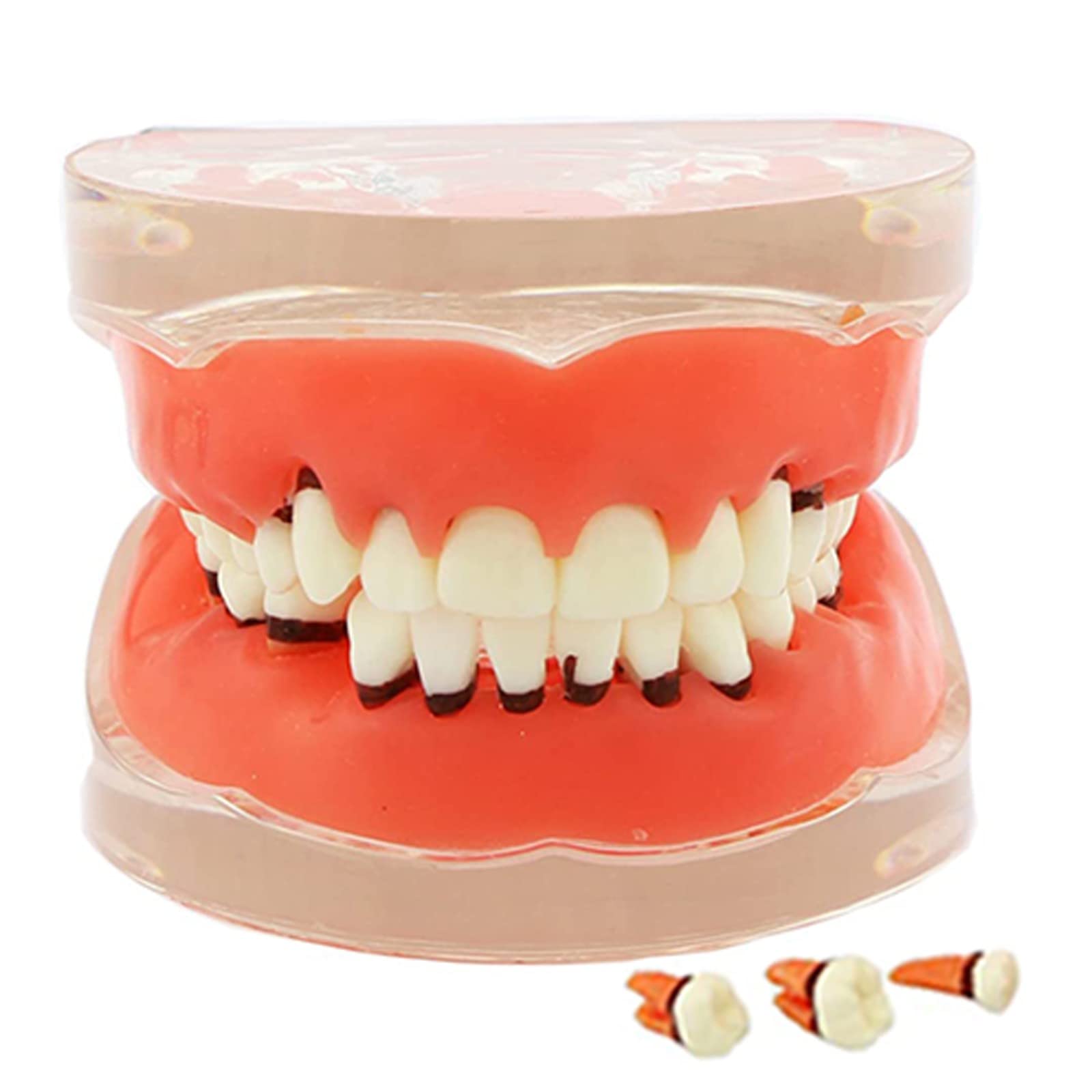 Modello Denti per Malattia Parodontale per Studio Odontoiatrico, Typodont con Gomme Morbide per Insegnamento e Formazione in Odontoiatria, Strumento Educativo Anatomico