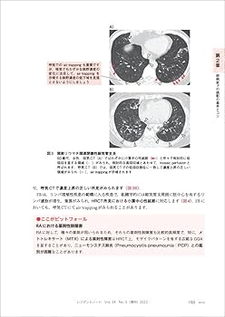 肺HRCT 原書5版 Amazon.co.jp: 肺HRCT 原書5版 : 西村 直樹, 松迫 正樹, 仁多