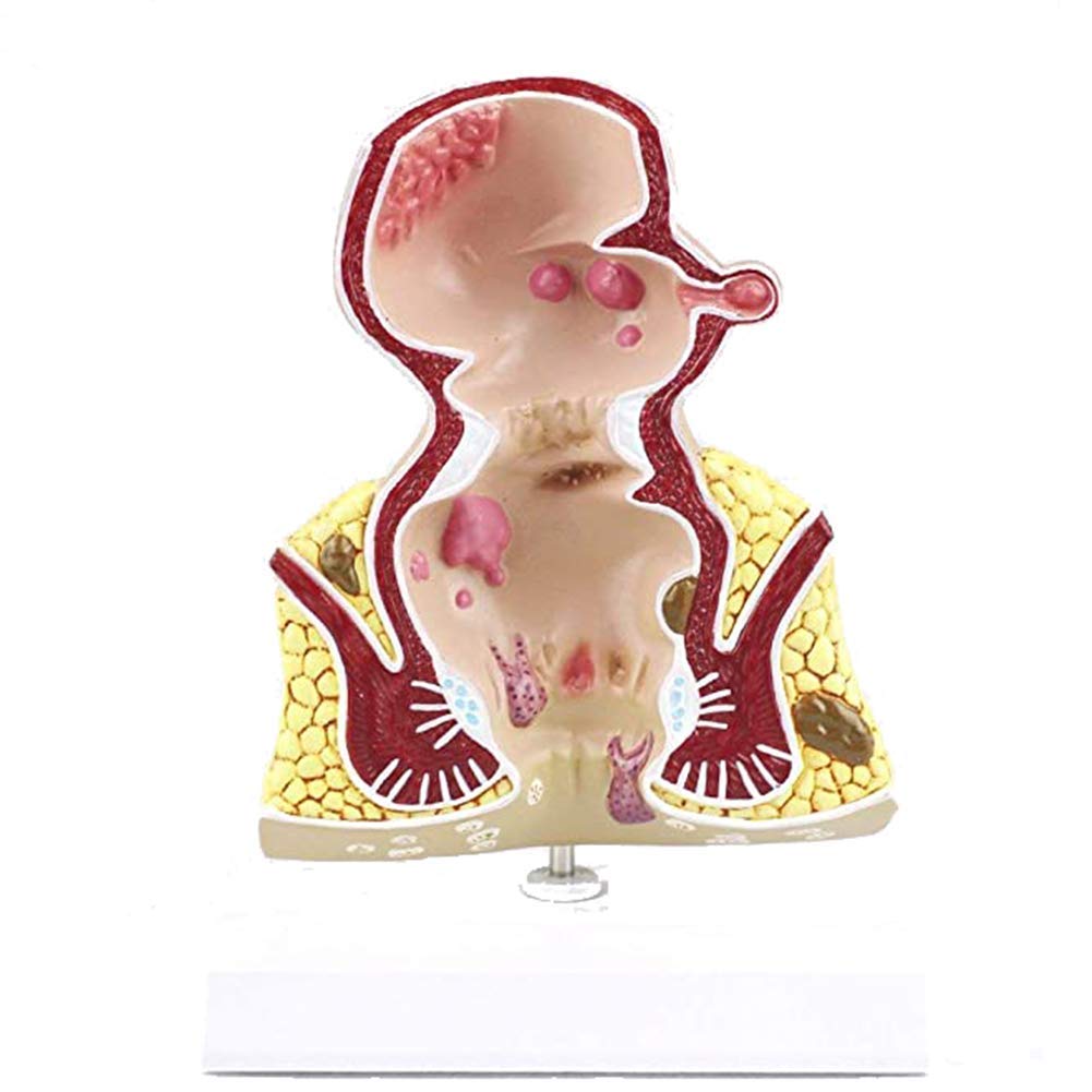 Sjdopulse Human Model Large Intestine Anatomy And Pathology Model, Reflecting The Pathology Of Hemorrhoids Through Doctor-Patient Communication And Medical Education