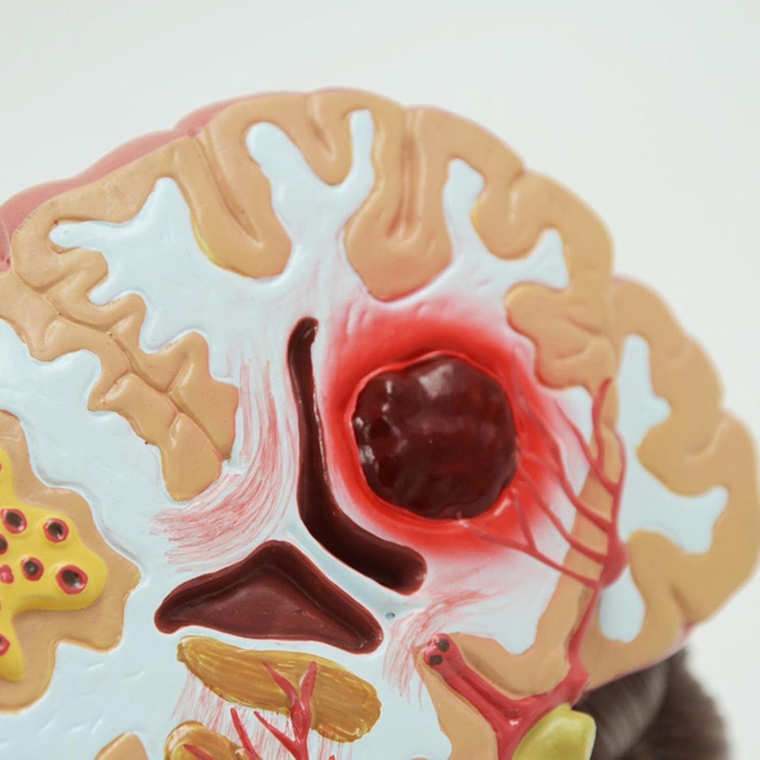 Human Brain Anatomical Model, Cerebral Hemorrhage Cerebral Arteriovenous Malformation Pathological Model, Neurology Medical Teaching Aid, Used for Research and Display