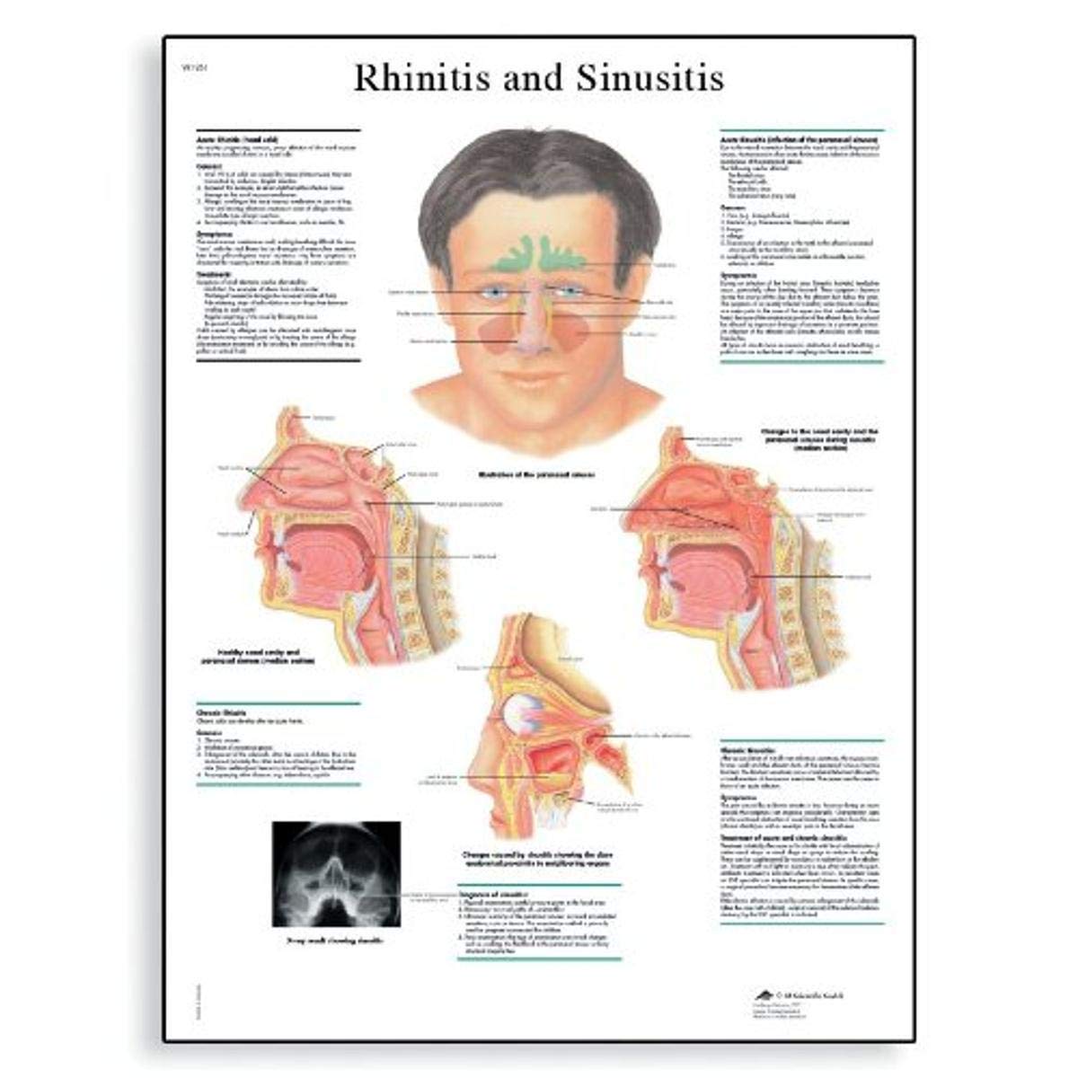 3B Scientific VR1251L Glossy Laminated Paper Rhinitis and Sinusitis Anatomical Chart, Poster Size 20" Width x 26" Height