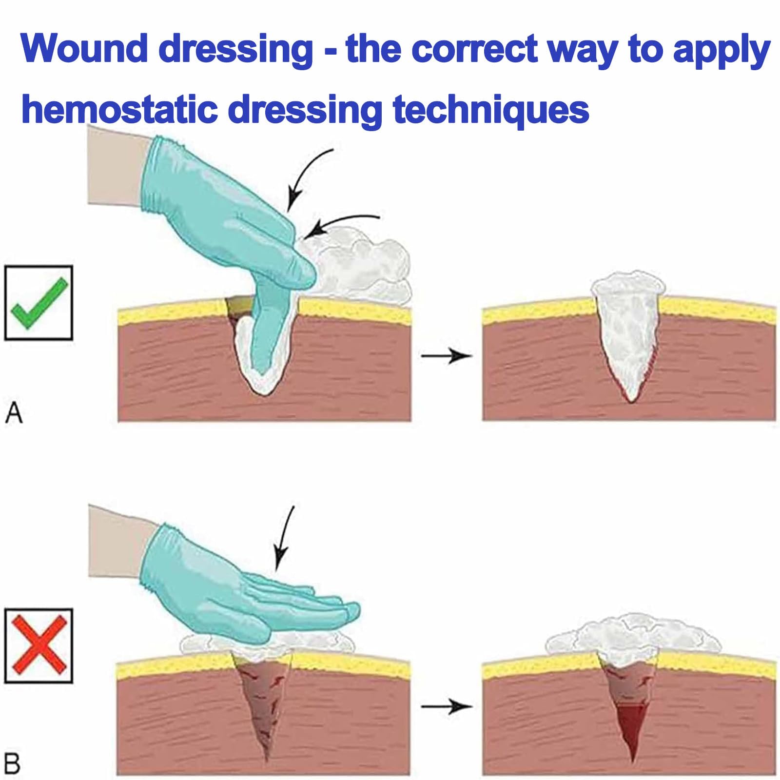 Simulador De Hemorragia, Modelo De Herida Stop The Bleed, Entrenador Relleno Muslo, Silicona, Reutilizable para Hemostasia Traumatismos Y Clases Médicas
