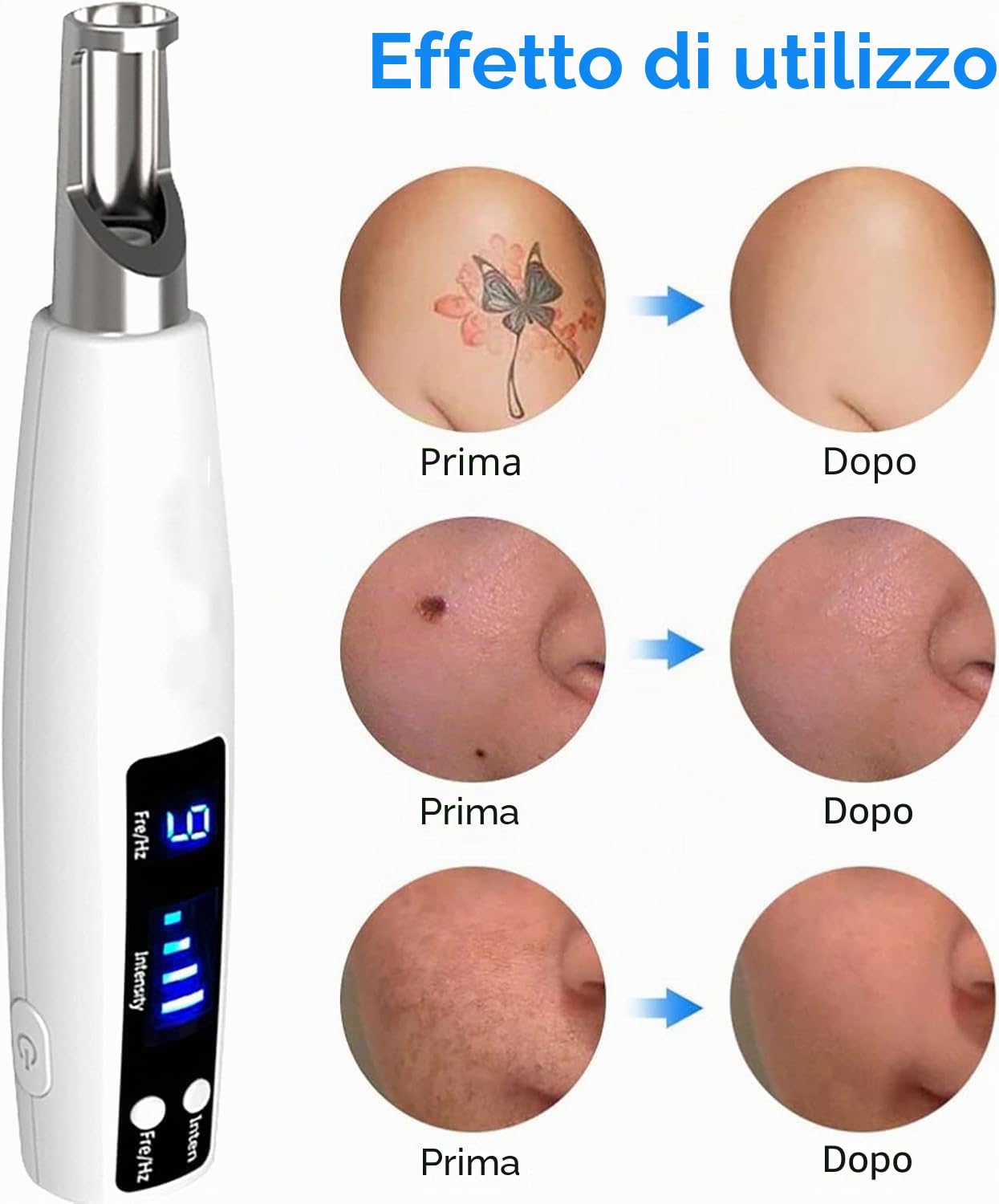 Penna di rimozione della macchia, penna di rimozione a pois per rimuovere il tatuaggio della cicatrice della penna di pic-secondo, 9 livelli di frequenza e 4 livelli di intensità,Blue Light
