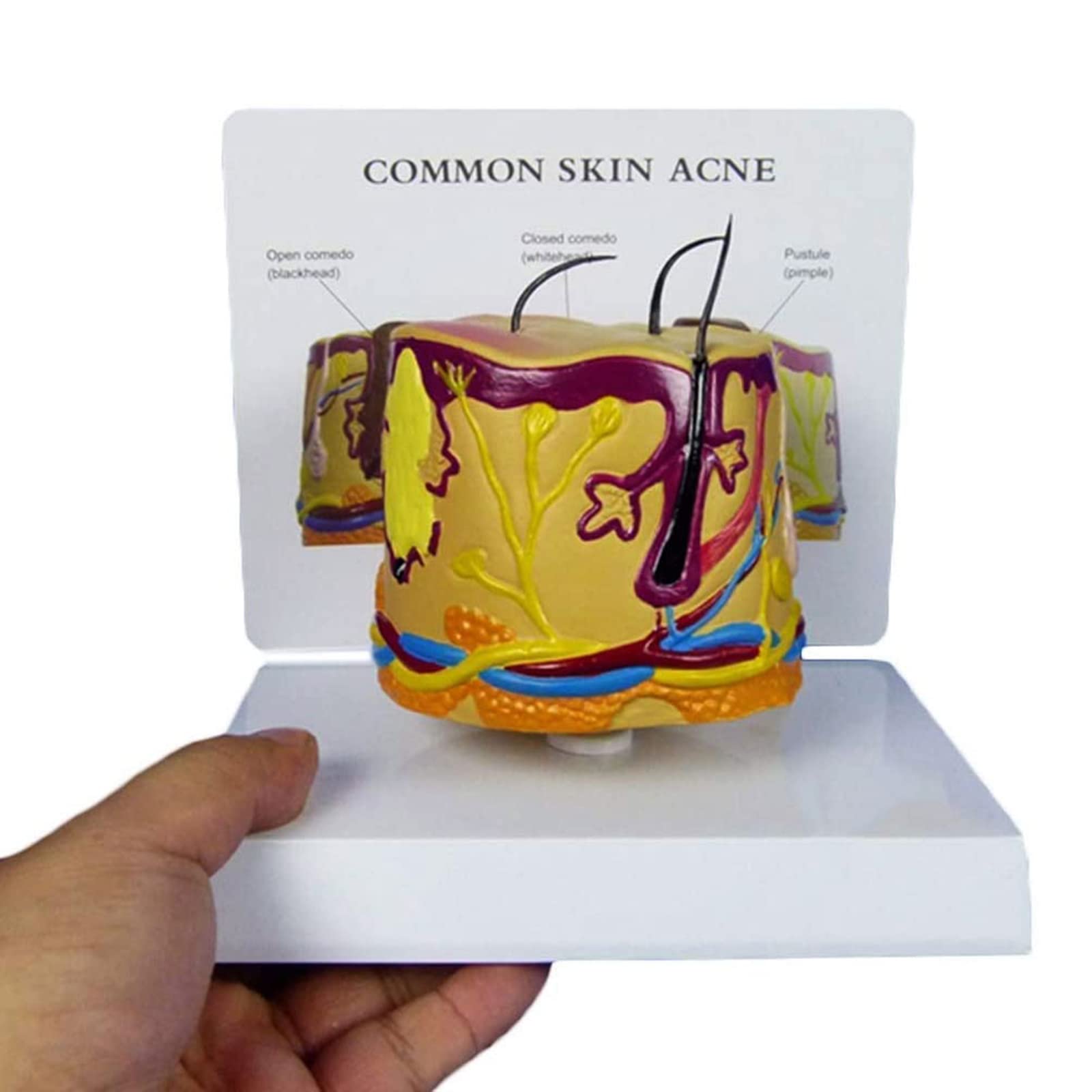 Skin Pustule Model Buy 35 Times Human Big Anatomical Skin Magnified Tissue Structure Model ...