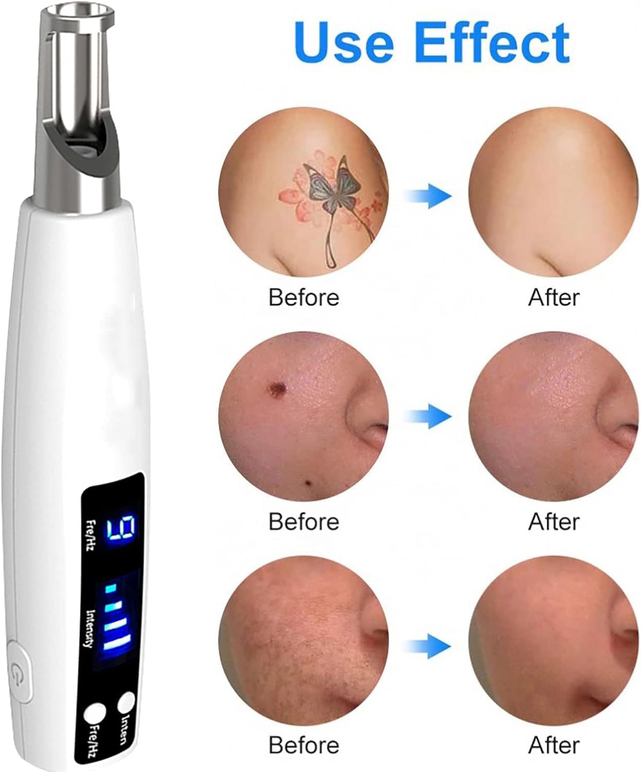 Stylo d'élimination des taches, stylo d'élimination des taches à pois pour enlever les tatouages cicatrices, 9 niveaux de fréquence et 4 niveaux d'intensité, Blue Light