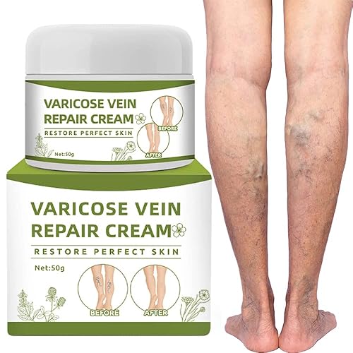 Crema de venas varicosas crema reparadora de venas arañas mejora la circulación sanguínea crema de tratamiento de venas varicosas para piernas dolor