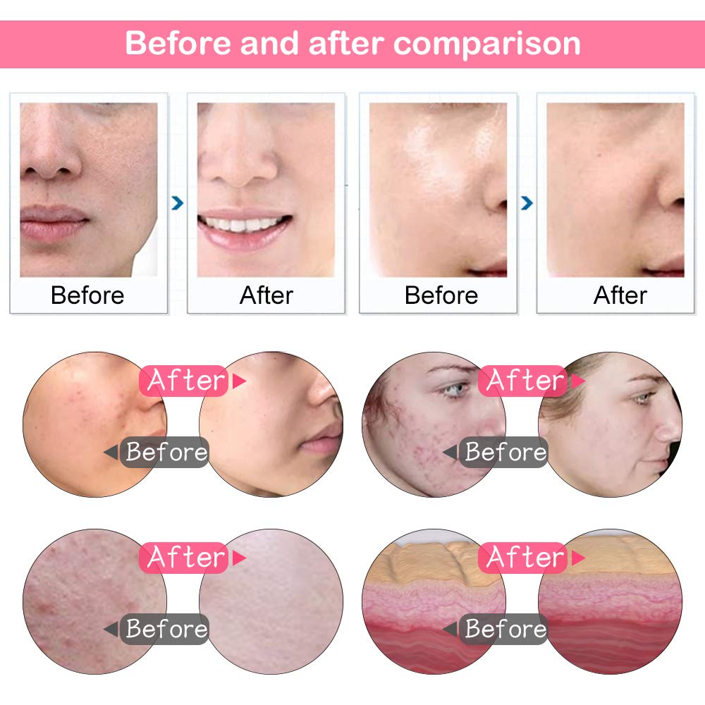 Macchina Microdermoabrasione Diamantata Professionale - Aspirazione 65-68 cmHg - Dispositivo Viso per Cura della Pelle, Testine Intercambiabili, Uso Domestico e Professionale