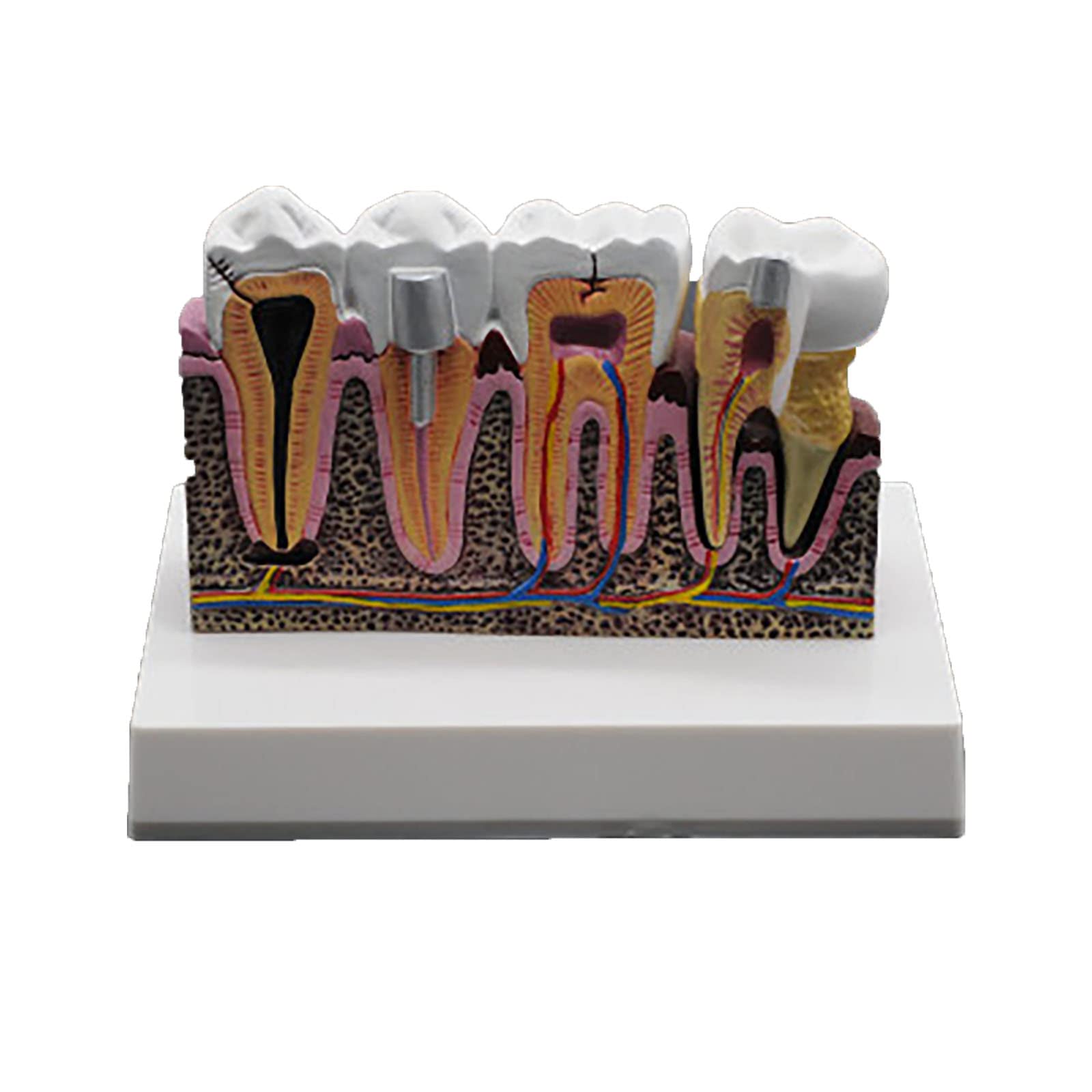 KJMWXOP Tooth Model, Caries Comparison Anatomical Tooth Model, Tooth Demonstration Model For Doctor-Patient Communication, Oral Disease Research