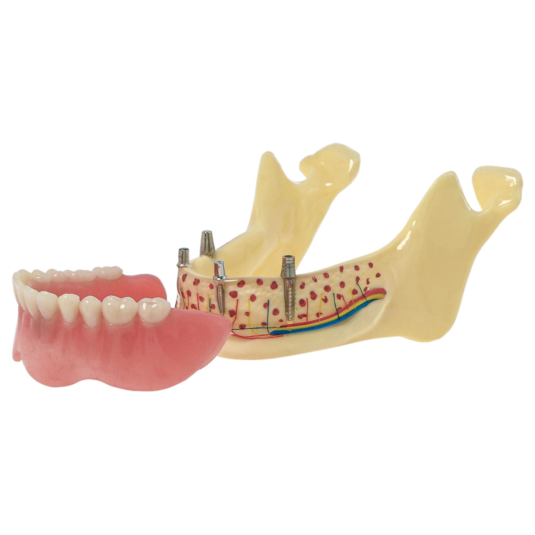 Dental Typodont Teeth Model with Implant Restoration and Overdenture, Demonstration and Practice Model