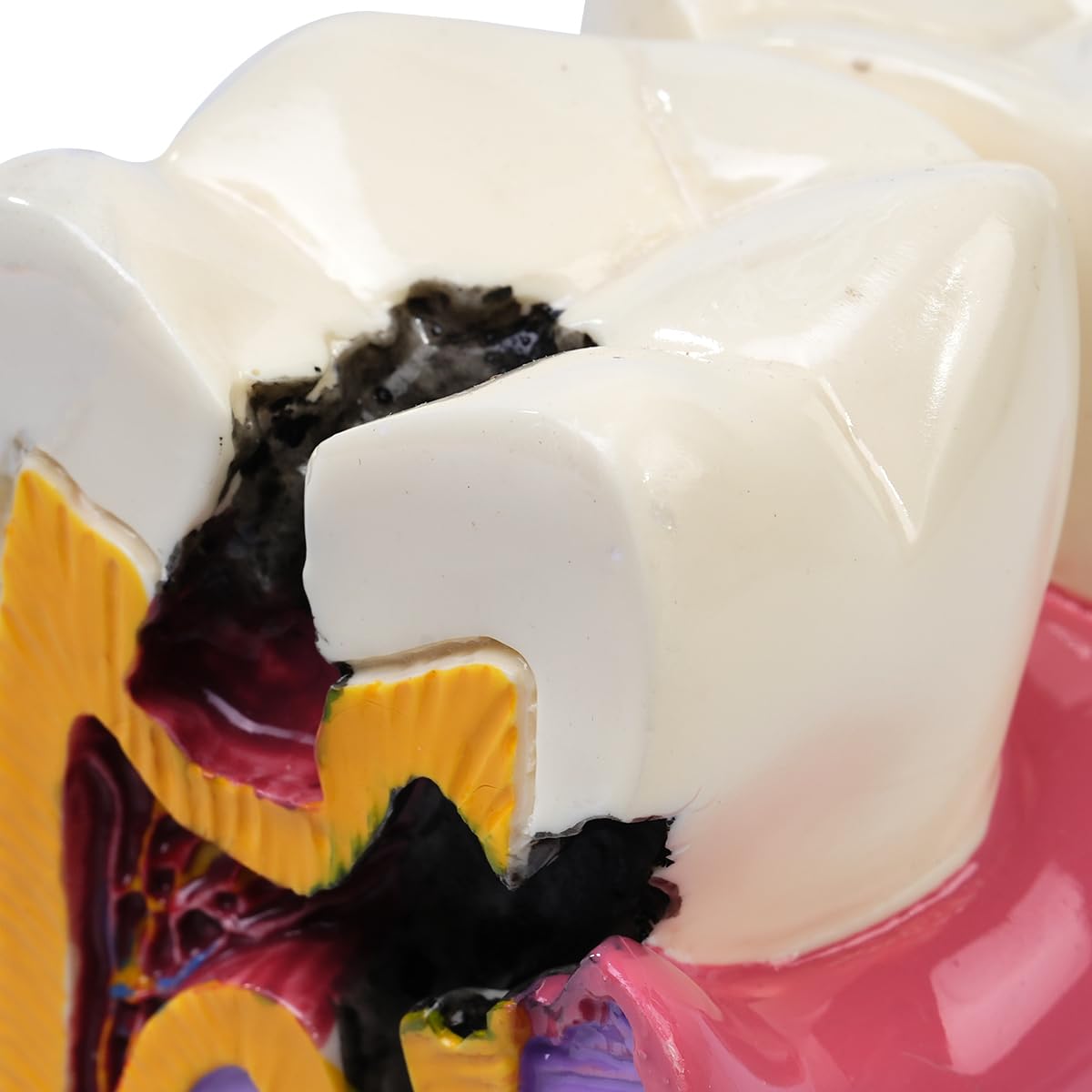 Sarini Modèle Dentaire, modèle d'étude de comparaison des Caries, modèle d'enseignement de l'anatomie Dentaire pour dentistes, adapté aux dentistes, aux Patients, aux Enseignants et aux étudiants