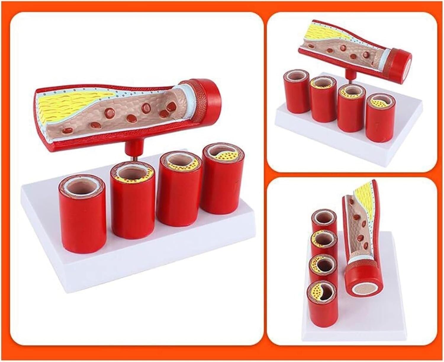 Cardiovascular Artery Coronary Artery Model Teaching pathological Blood Vessel Model, Suitable for Doctors' Offices and classrooms, Medical Learning Resources