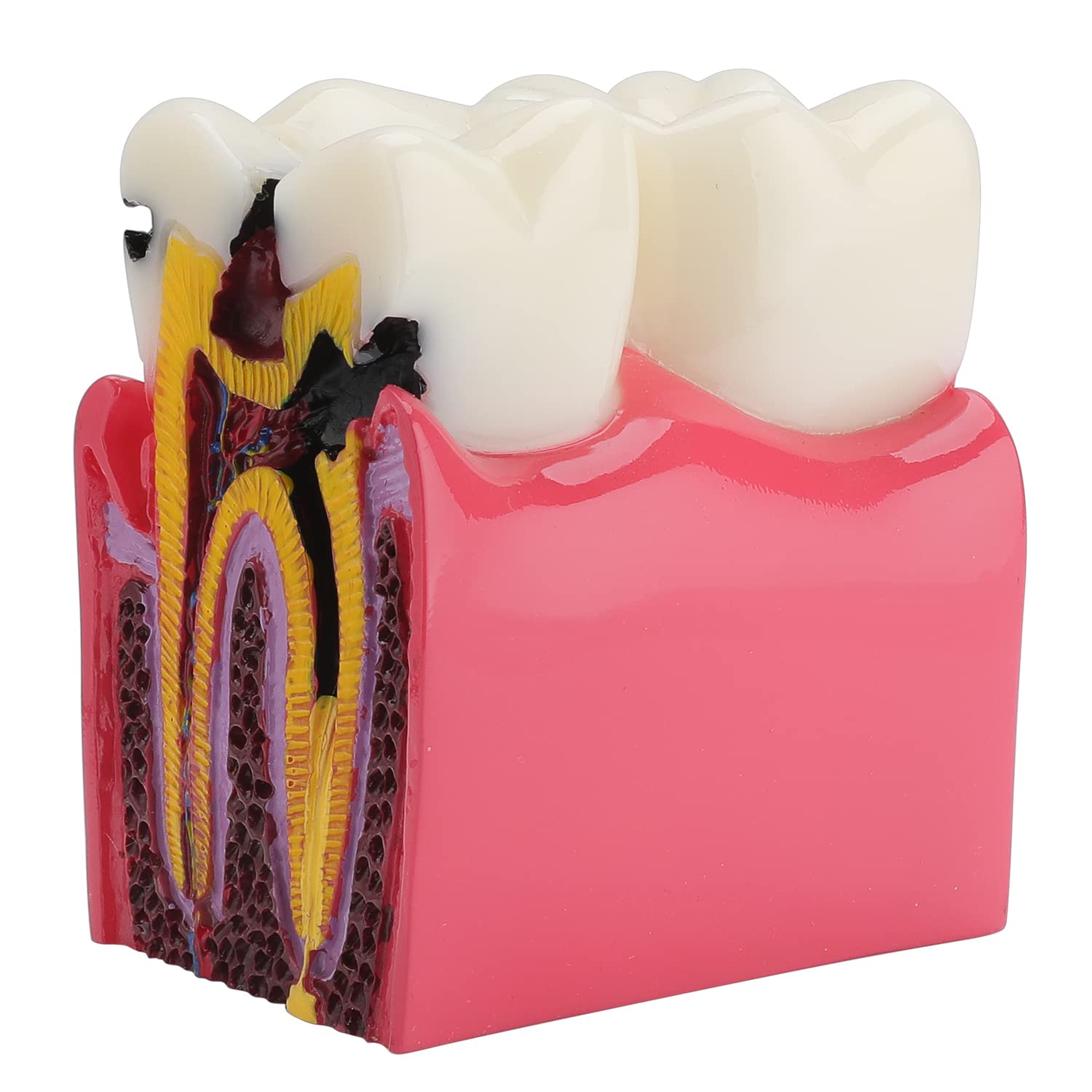 Dental Caries Tooth Model - 6 Times Caries Anatomy Dental Care Teeth Model Decay Teeth Comparative Education Model Dental Model Teaching for Patient Education