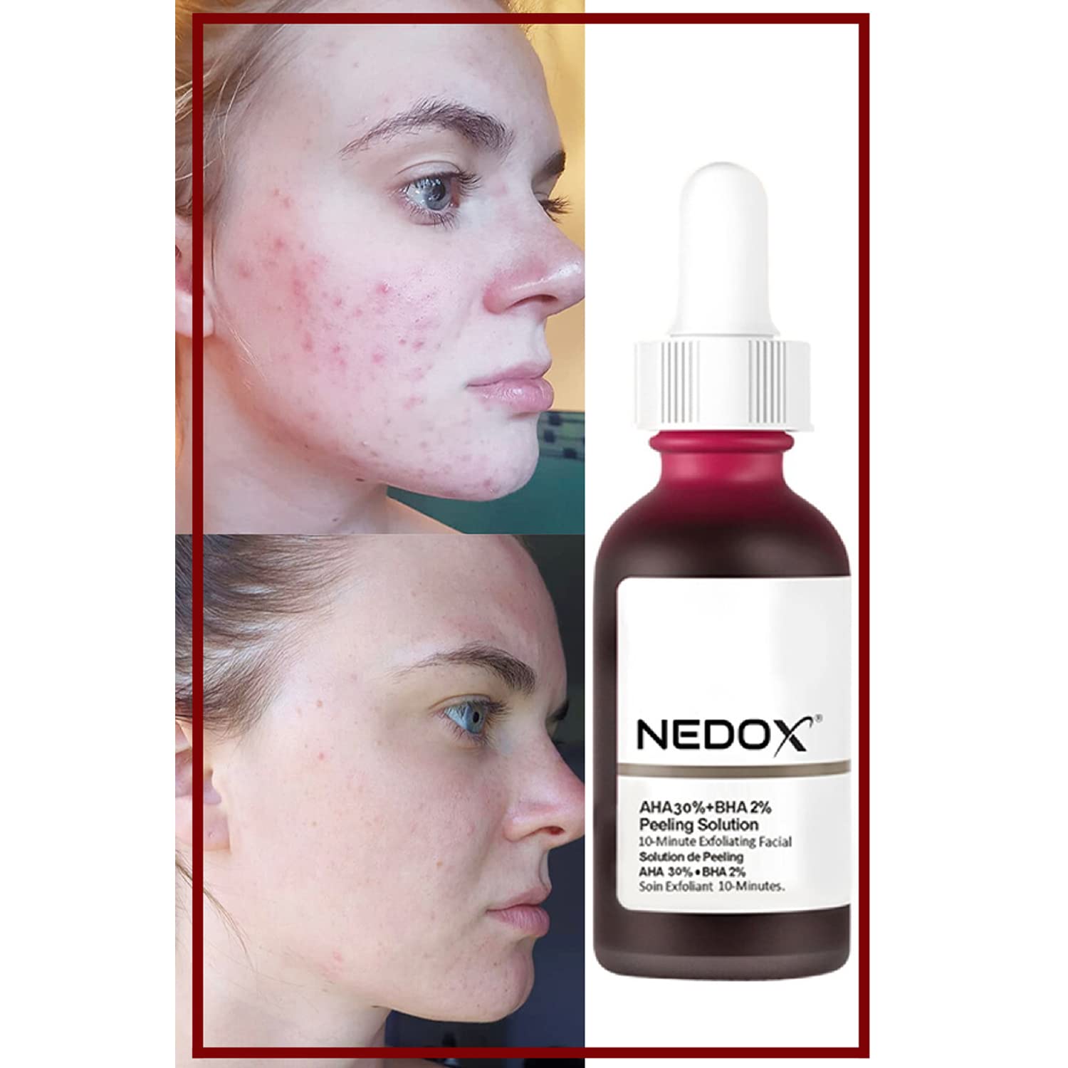NEDOX Cilt Yenileyici Cilt Tonu Eşitleyici Kırmızı Peeling Serum Aha %30 Bha %2 Ph % 3.5 Serum 30 ml