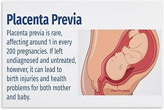 Placenta Praevia Guide Poster Hospital Obstetrics And Gynecology (4) Canvas for Bedroom Living Room Decor 36x24inch(90x60cm) Unframe-style