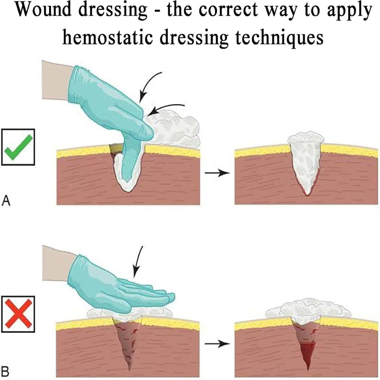 Simulador de Vendaje de heridas, simulador de laceraciones, Reutilizable, Kit de formación «Stop The Bleed», para formación en Primeros Auxilios Militares y educación médica