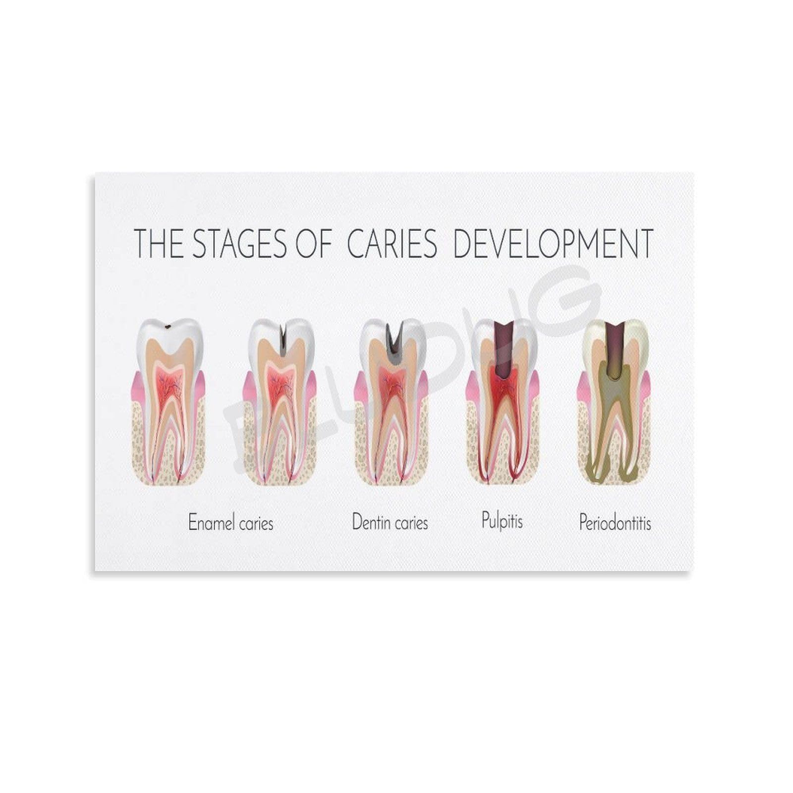 BLUDUG Dental Infographic Poster Posters of The Stages of Caries Formation Canvas Painting Wall Art Poster for Bedroom Living Room Decor16x24inch(40x60cm)