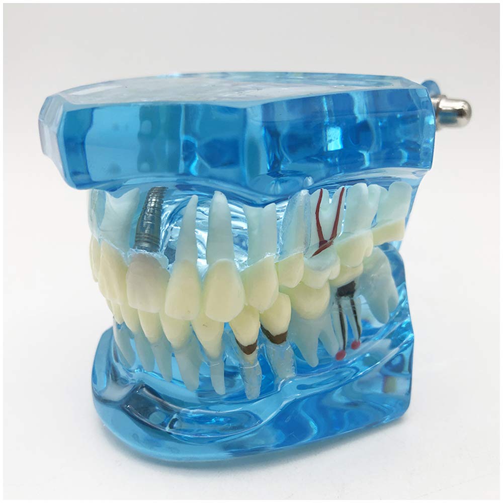Modello di Denti da 2 Pezzi, Modello di Analisi di Studio di Impianti Dentali per Riparazione di Carie Dentale, Modello Dimostrativo per L'Insegnamento Medico, Forniture di Laboratorio