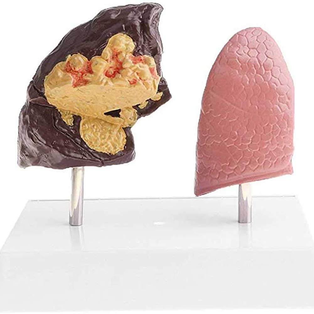 Sjdopulse Human Healthy Lungs And Pathological Lungs Comparison Model—Normal Pathological Lungs Comparison Pathological Lungs Anatomy Cutaway Model