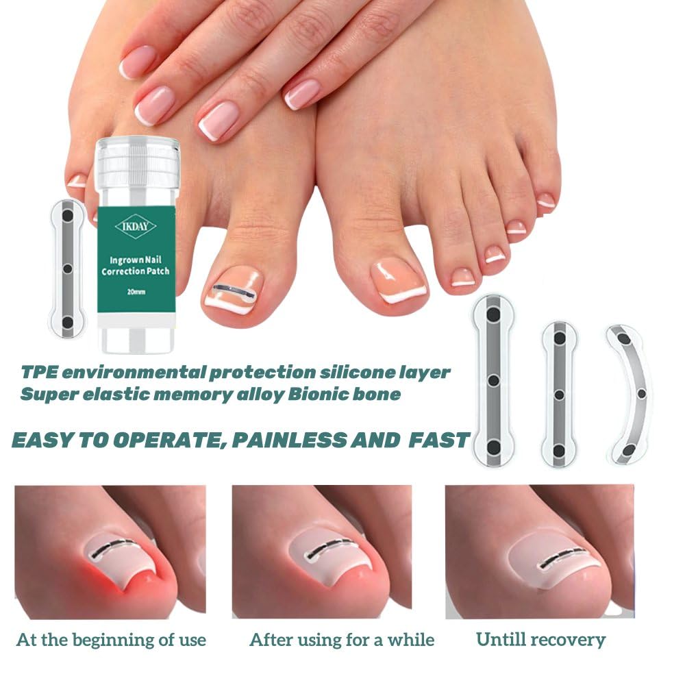 Ingrown Toenail Corrector & Removal Kit - at Home Treatment for Ingrown Toenails, Titanium Alloy Ingrown Toenail Treatment Tools Designed for Curved Nail Repair Suitable for Men Woman (0.59/0.67in)