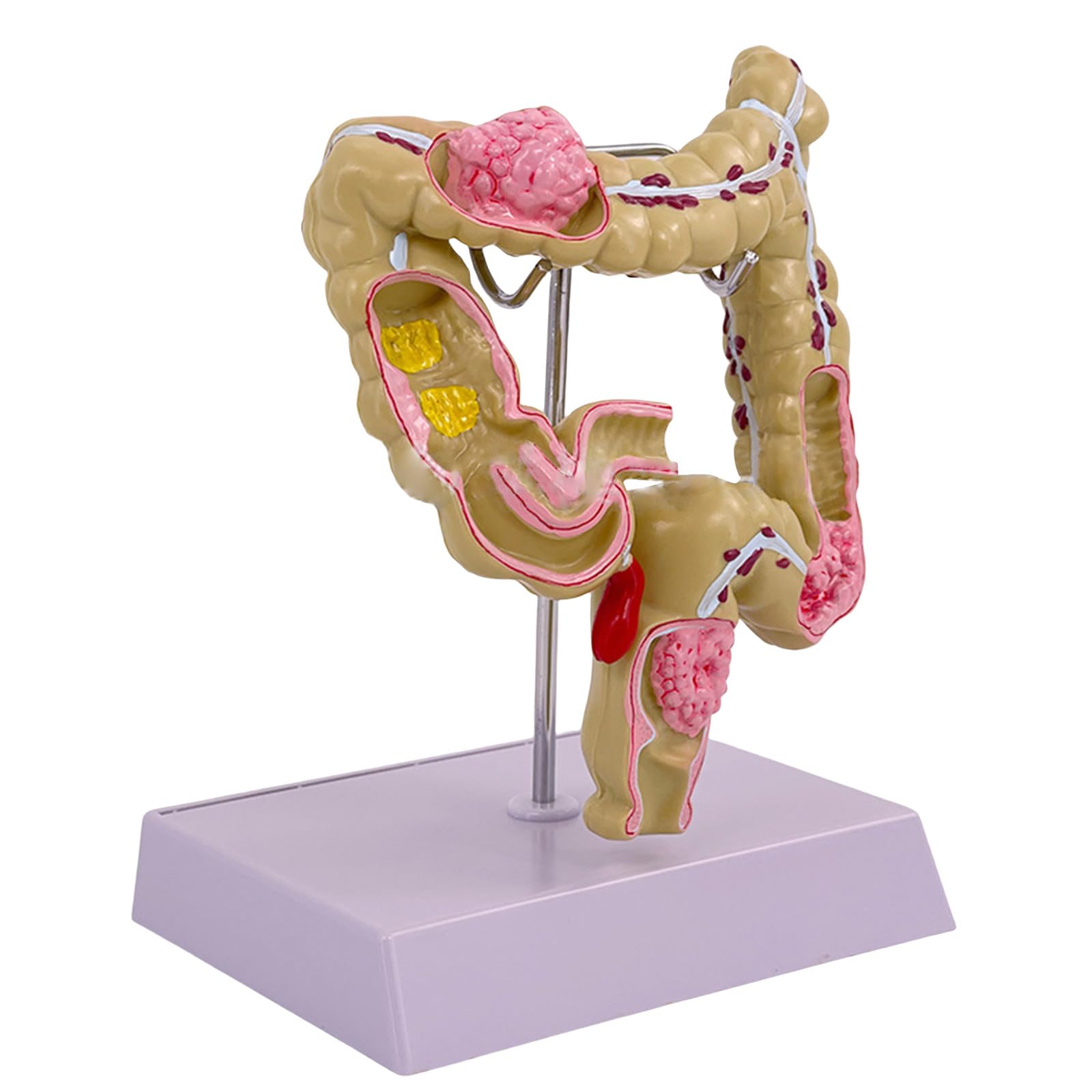 Modello umano dell'intestino crasso Patologie umane del modello dell'intestino crasso Strumento didattico per studi scolastici di laboratorio Patologie del modello dell'intestino crasso Modello di