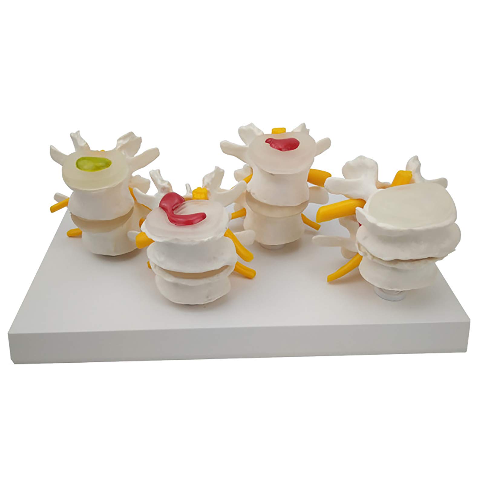 Spine Lumbar Disc Herniation Model - Human Lumbar Vertebral Spine Anatomy Model - The Diseased Model of Vertebrae - Lumbar Lesion Model Anatomical Disc Herniation Model Spine Anatomy Model