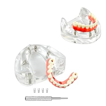 New Dental Implant Model, YOUYA DENTAL All-On-4 Implants Lower Jaw Malone Bridge Teeth Models, Dental Overdenture Teeth Model with Removable Recondition Implants for Education Teaching