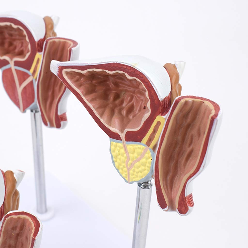 Model Prostaty Naturalnej Wielkości - Prezentacja Normalnych I Uszkodzonych Modeli Prostaty Porównaj Modele - Materiał Pcv Modele Naukowe Anatomii Człowieka - Do Wyświetlania W Badaniach Model Naucza
