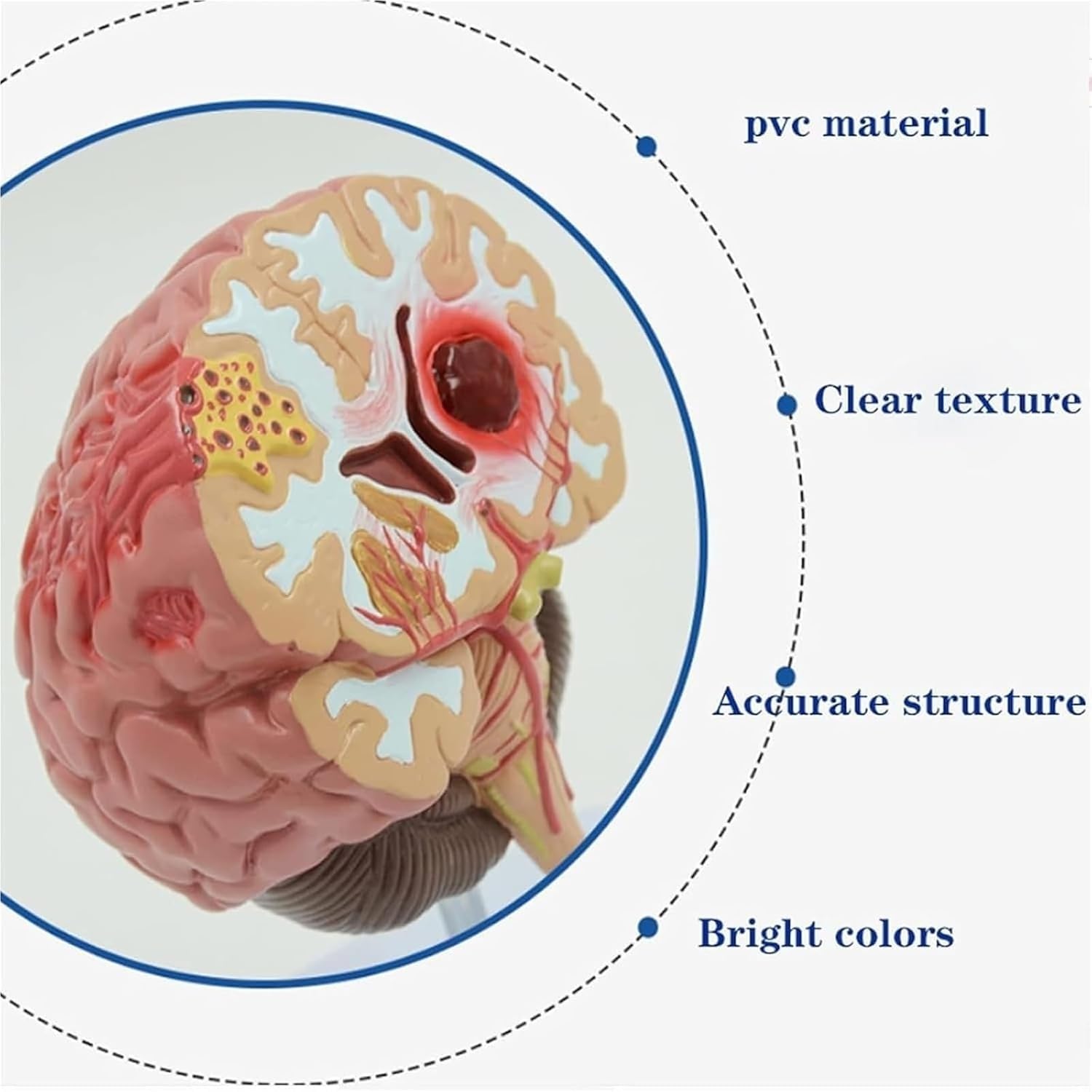Human Brain Stroke Model,Cerebral Hemorrhage Cerebral Arteriovenous Malformation Pathological Model, Life-Size Human Brain Structure, for Doctor Education and Training Display.