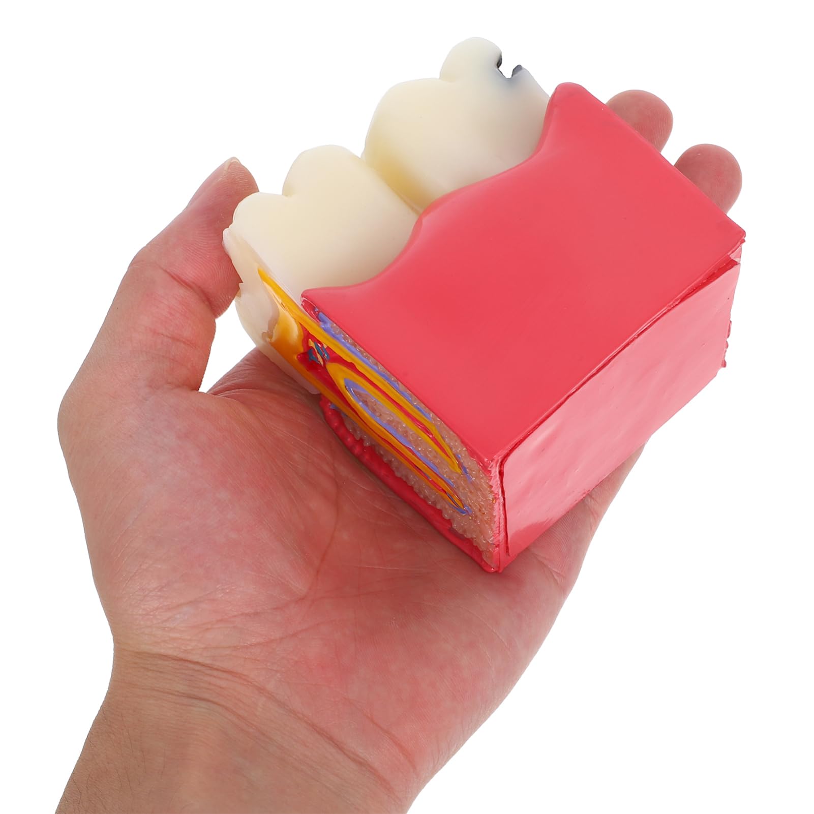 Alipis Modèle D'enseignement Comparatif de Carie Dentaire en Résine pour Dentiste Simulation Précise, Application Polyvalente pour L'éducation à Domicile et Scolaire